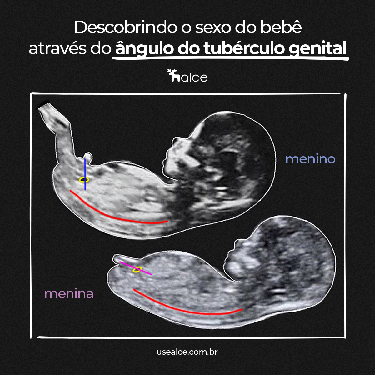 Tuberculo genital como descobrir o sexo do bebê